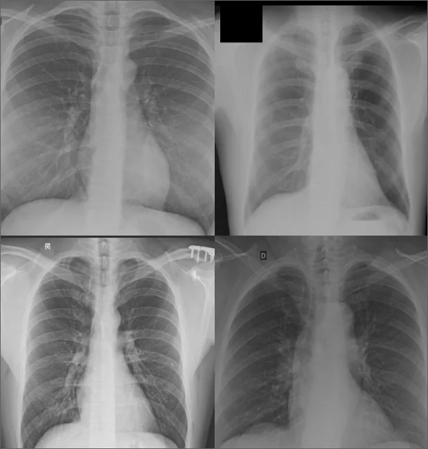 ImageSlide<b>흉부 X-Ray 기반 성별과 나이 분류</b>