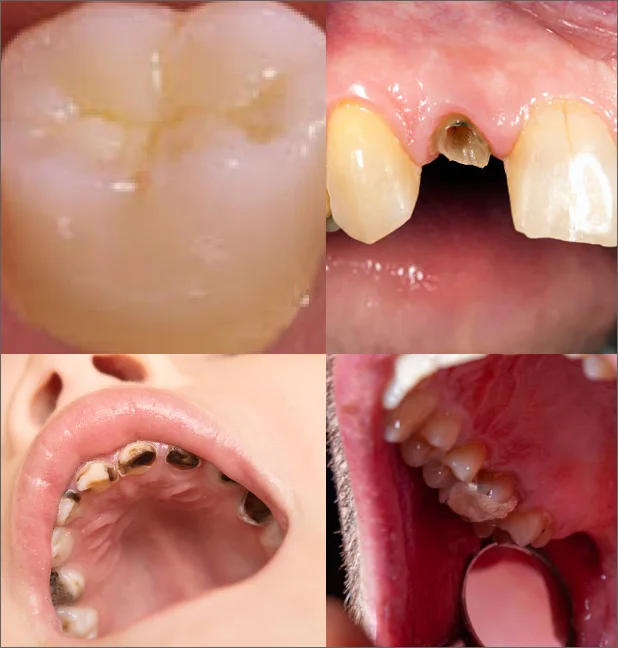 ImageSlide<b>충치 분류</b>