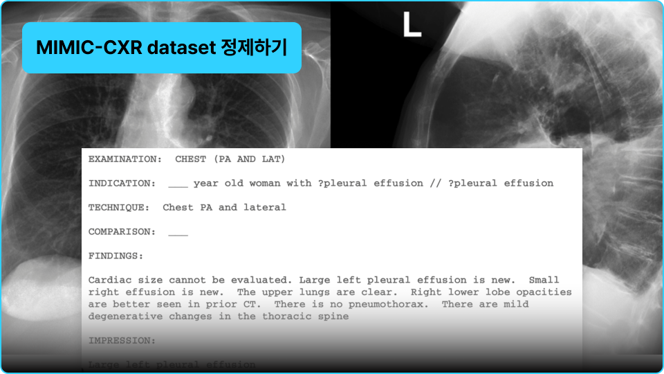 ImageSlide<span sytle="color:#333333;">흉부 엑스레이 이미지를 모아둔 MIMIC-CXR dataset의 판독문을 이용하여비정형 데이터를 정제하고 분석하는 방법을 배워봅니다.</span>