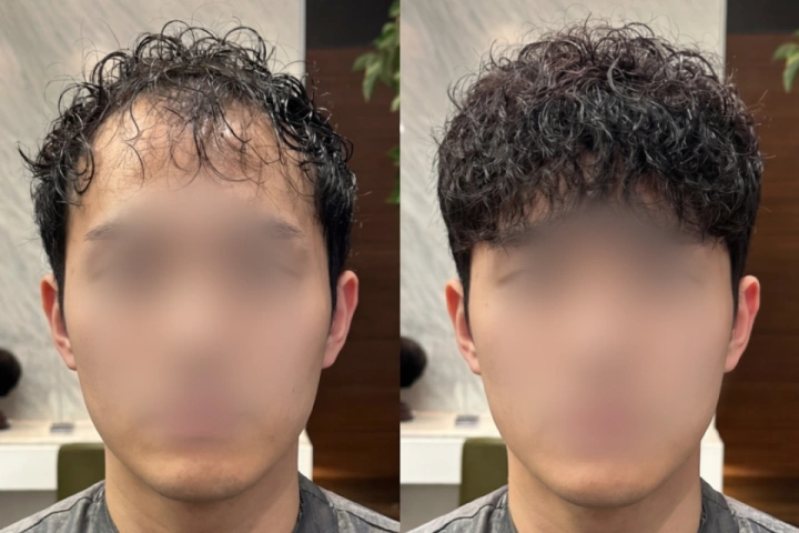 <p>실전에 바로 적용하는 탈모 유형별 시술 선택 기준</p>