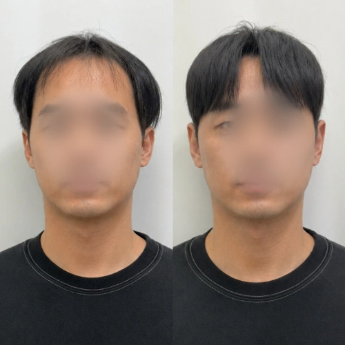 증모술전문가, 은파 강의예제